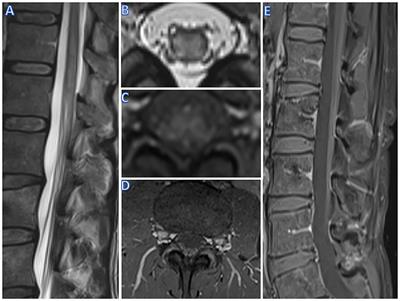 Acute Polyradiculomyelitis With Spinal Cord Gray Matter Lesions: A Report of Two Cases